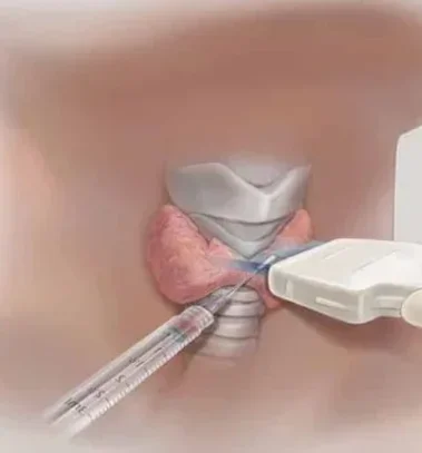 Фото для Лечение без операции кист и узлов щитовидной железы. Этаноловая склеротерапия под контролем УЗИ первичная (1 узел)
