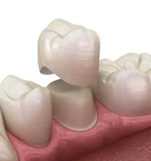 Фото для Восстановление зуба пломбой с использованием материалов из фотополимеров, зуб под коронку