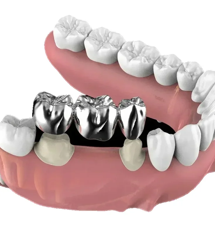 Восстановление целостности зубного ряда несъемными металлическими мостовидными протезами
