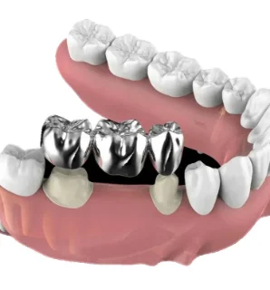 Фото для Восстановление целостности зубного ряда несъемными металлическими мостовидными протезами