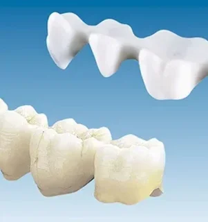 Фото для Несъемное протезирование: Восстановление зуба вкладкой