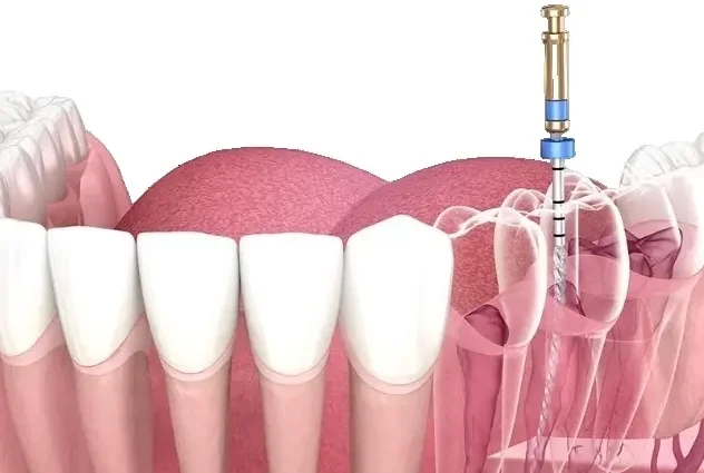 Лечение одного канала (постоянный зуб)