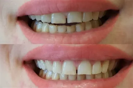 Экспресс отбеливание зубов
