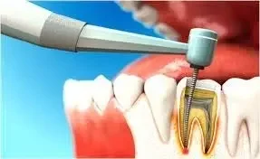Фото для Пломбирование одного канала зуба