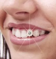 Декор зуба