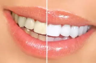 Аппаратное отбеливание зубов