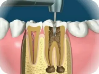 Первичное эндодонтическое лечение зуба (пульпит) 